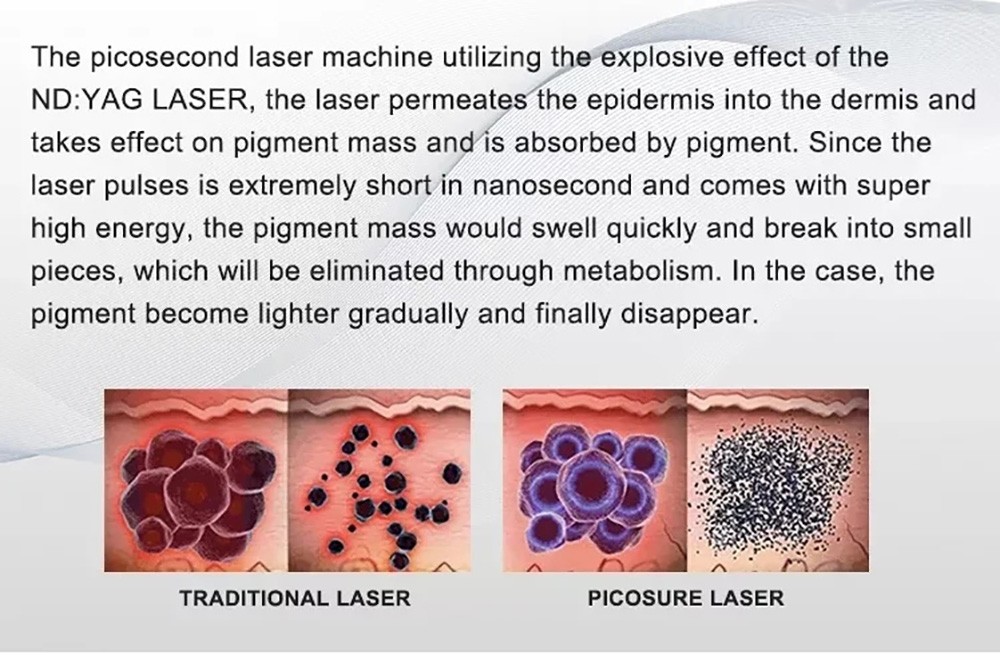 Pico Laser Beauty equipment ND YAG Laser Black Tattoo Removal peel machine
