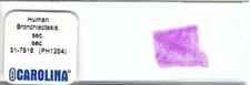 Human Bronchiectasis Pathology Microscope Slide