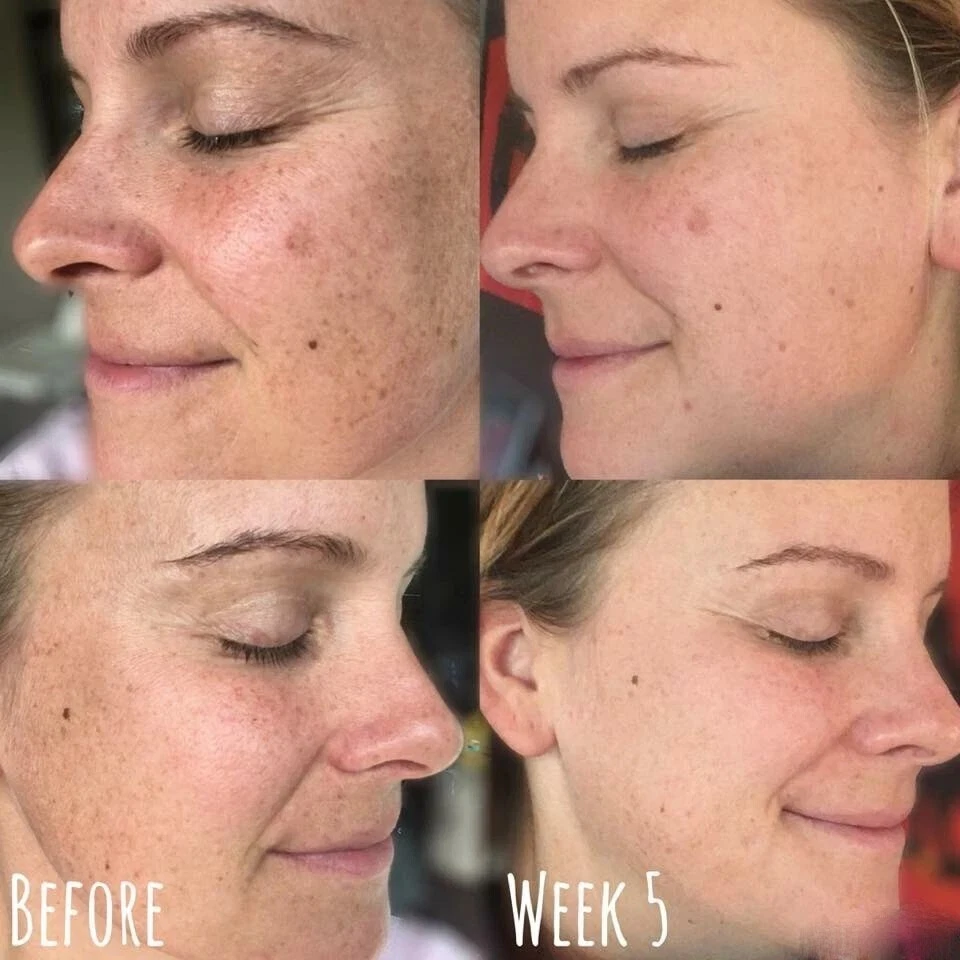 KOJIC ACID Skin Whitening Lightening Brightening Serum Bleaching/Spot Fade Cream - Image 2 of 4