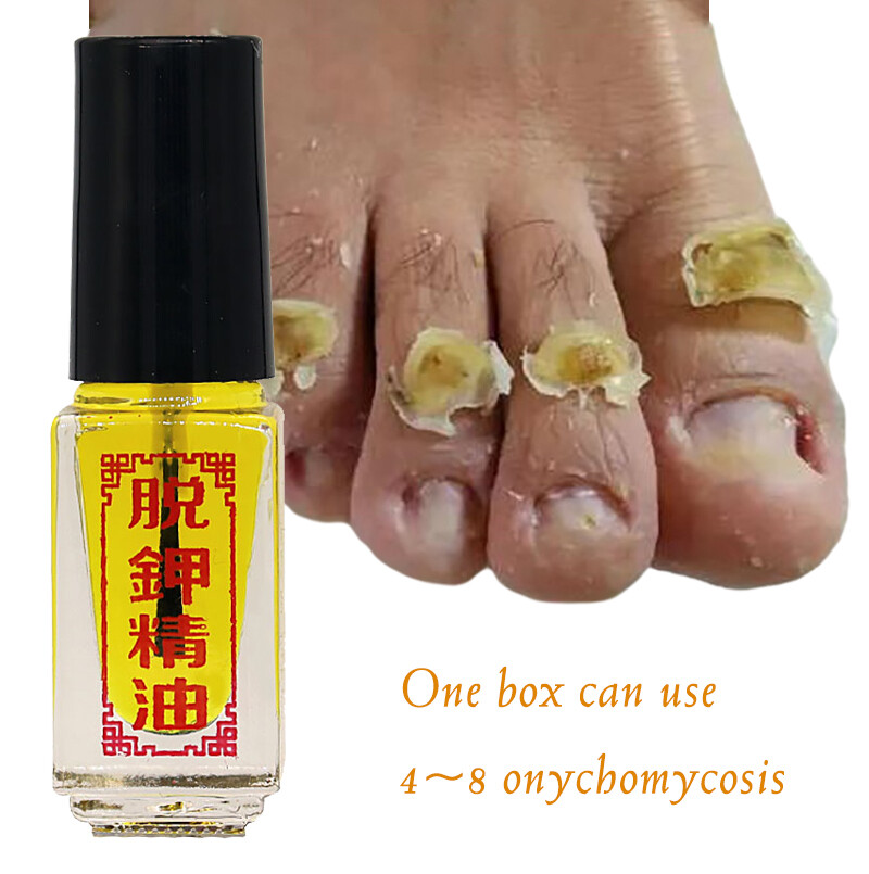 灰指甲擦什麼藥最有效？