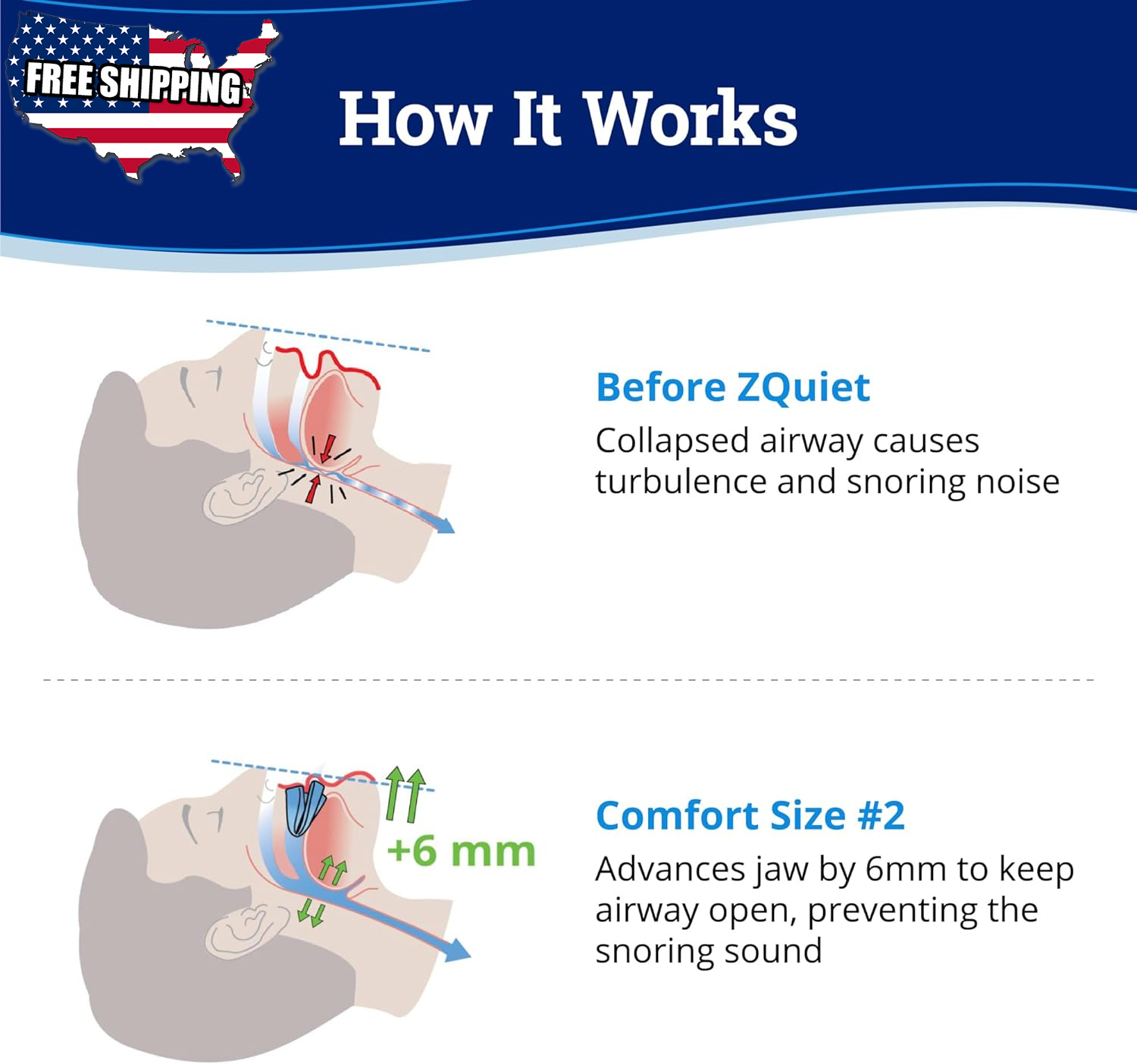 ZQuiet Anti Snoring Mouthpiece Solution Comfort Size 2 Single Device