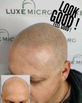 Scalp Micropigmentation Hair Tattoo For Hair Loss