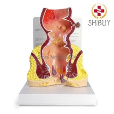 Rectum Model Human Body Anatomy Replica of Rectum W/Common Pathologies Model