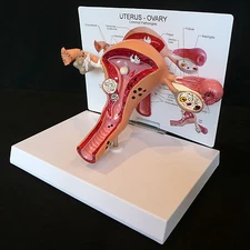 Pathological Uterus and Ovary Anatomical Model - Human Female Medical Anatomy 