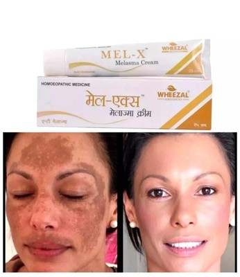 Wheezal Mel-X melasma Cream (25g) for skin pigmentation like melasma, chloasma