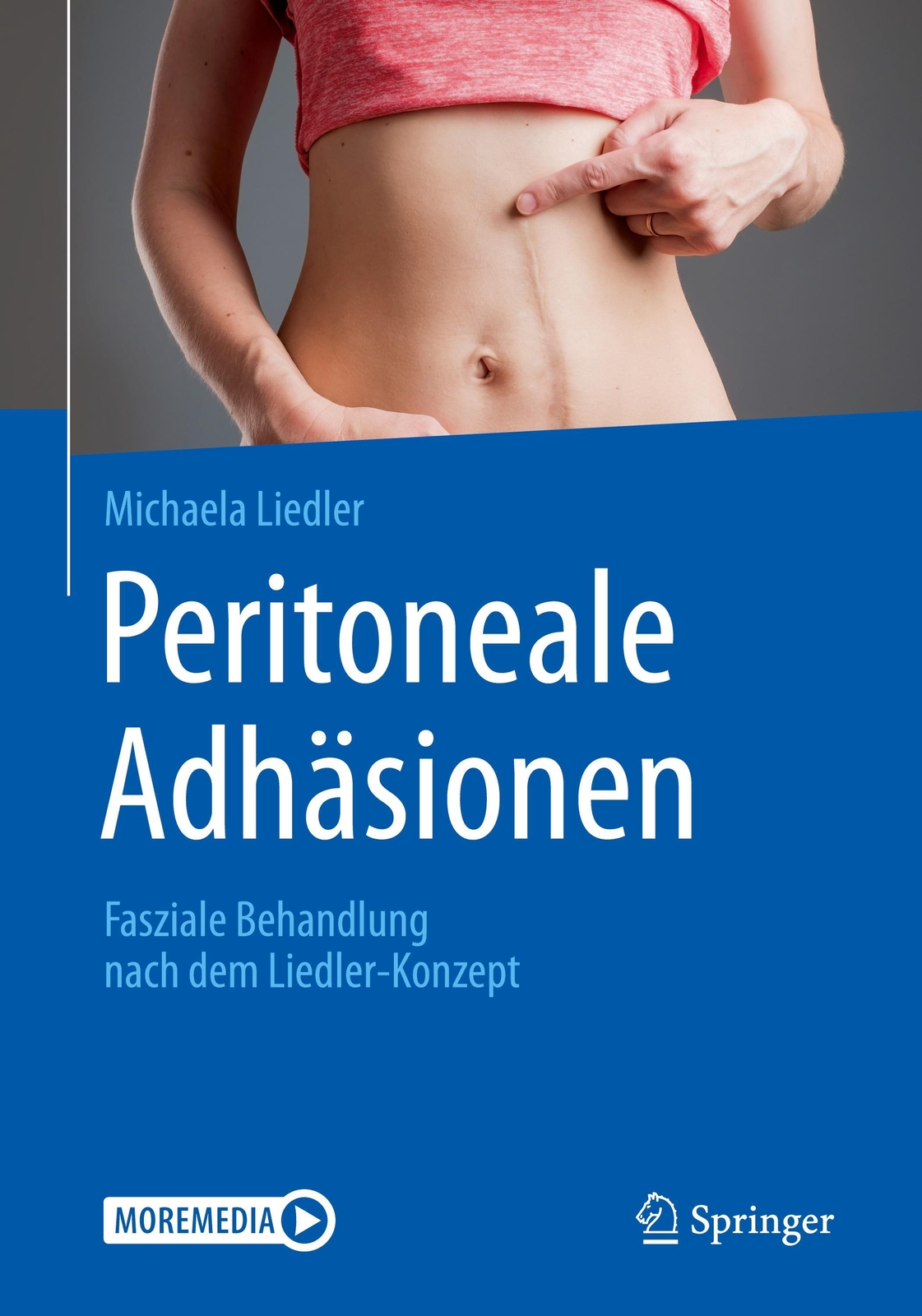 Thumbnail - Peritoneale Adhäsionen Michaela Liedler