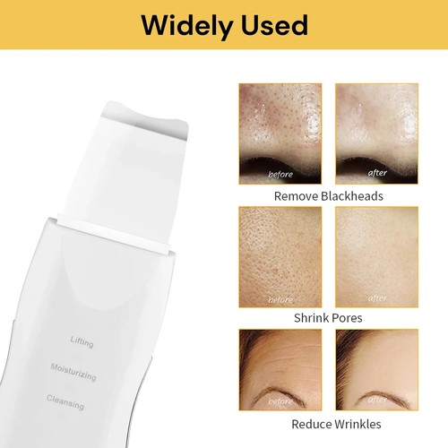 Ultrasonic Facial Skin Scrubber Face Spatula Rechargeable Skin Blackhead Remover - Picture 9 of 14