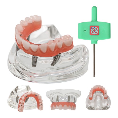 US Dental All-on-4 Overdenture Implant Model, Upper/Lower Jaw-Clear,With 4 Screw - Picture 24 of 51