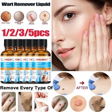 1-5PC Wart Remover Liquid Skin Tag Mole Remover Eliminate Feet Corn Wart Remove