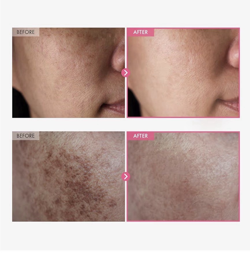 TOSOWOONG Arbutin 7.0+TXA 4.0 Cream 50ml Arbutin 7%, Tranexamic