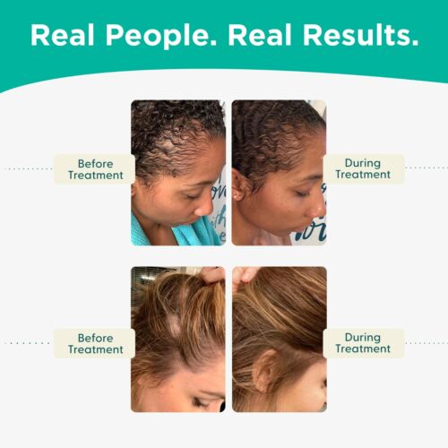Shapiro MD Hair Loss Conditioner, Vegan Formula, DHT Blockers for Thinning Hair - Picture 6 of 6