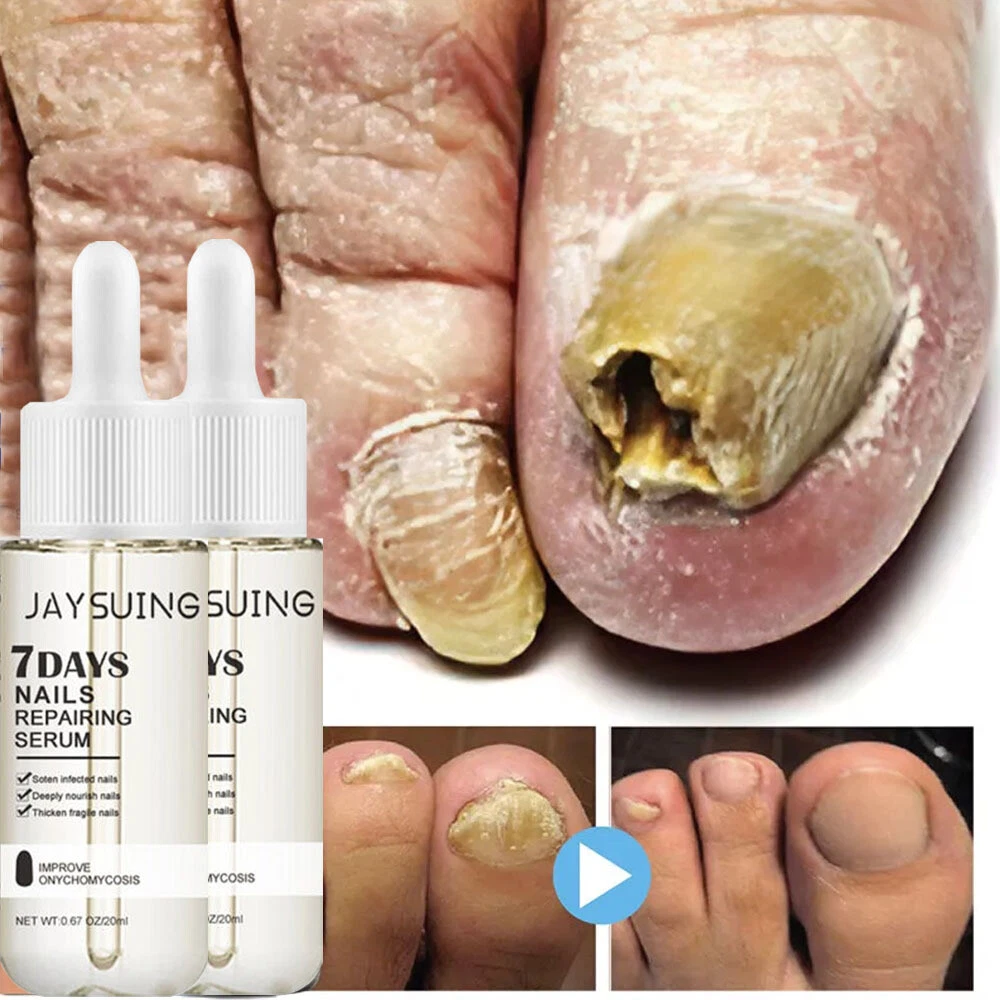 Discover 178+ tablets for fungal nail infection super hot nhuaanphu