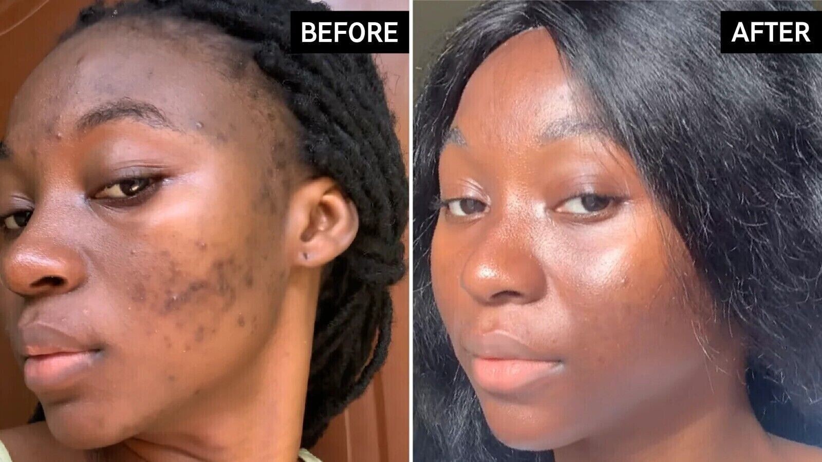 Tranexamic Acid Face Serum for Dark spots, Brightening, Discoloration Treatment eBay