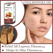Chalmogra Oil For Skin 60ML  Ayurvedic Chalmogra Oil 60 ML