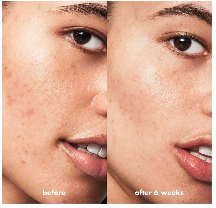 e.l.f. SKIN Blemish Breakthrough Blemish Fighting Spot Gel, Roll-on