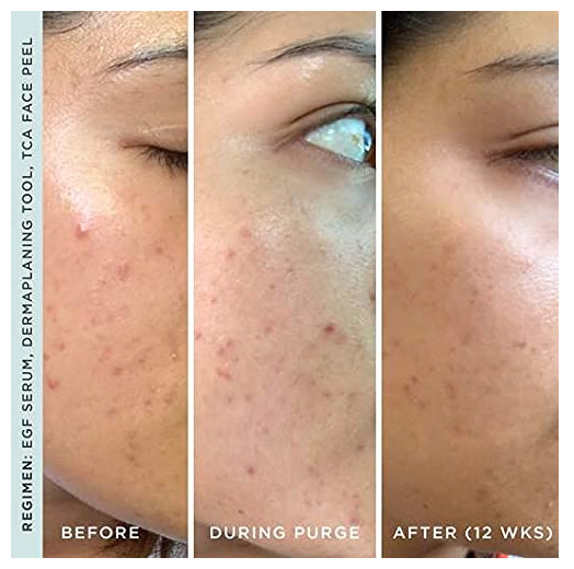 Stacked Skincare Activating EGF Serum Hyperpigmentation Skin Care Face Treatment