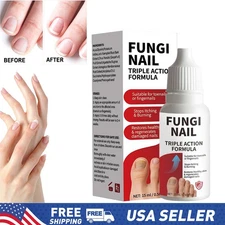 Fungi Nail Anti Fungal Liquid Formula Nail Repair Liquid Solution 15ml