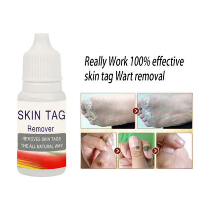 10ML Warzen Entfernung Behandlung Haut Tag Entferner Wart Corn Remover Skin Mole
