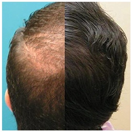 CapillusOne Cap Lasers for Hair Regrowth eBay