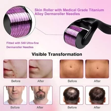 0.5mm 1mm 1.5mm 2.0mm 540 Microneedle Scar Derma Roller Dermaroller