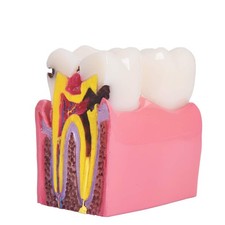 Dental Caries Teeth Model,Dental Anatomy Education Tooth Model,6 Times Caries...