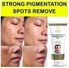 Anti-Pigmentation Blemishes Spots Removal Face Cream 100g For UNISEX Best Result