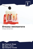 Twinkle Modi (U. A.) | Otkazy Implantata | Taschenbuch | Russisch (2024)
