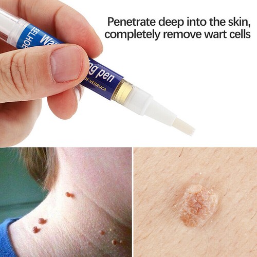 12 Hours Wart Remover Pen Skin Tag Mole Remover Eliminate Foot Corn Warts Unisex - Picture 5 of 12