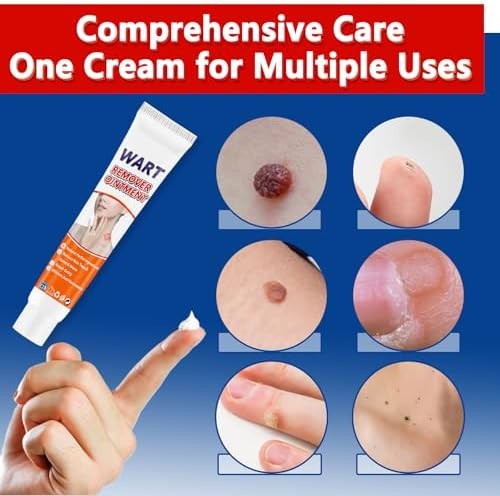 Wart Remover Cream 20g Effective Verruca Treatment Freeze Removal of Corns Spot - Picture 2 of 8