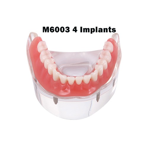 US Dental Implant Disease Teeth Model Overdenture Implants Upper/Lower