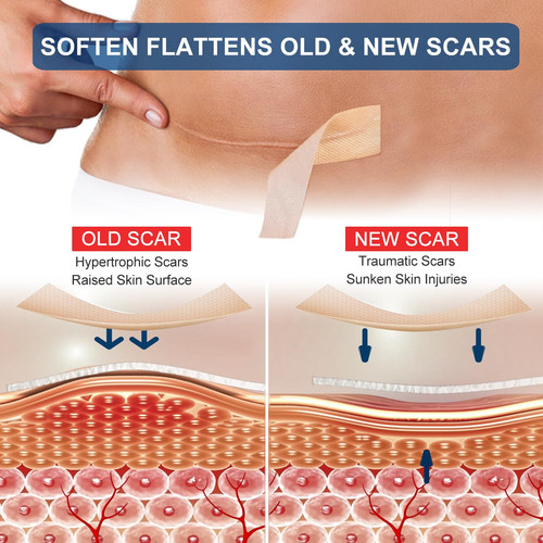 Silicone Scar Sheets (1.6” x 120” Roll-3M), Tape Roll, Scar... - Picture 3 of 11