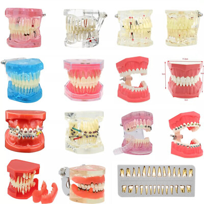 Teeth Model Dental Typodont Ortho Implant Pathological Perio Practice Demo Model
