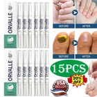 3-15X Orville Nail Fungus Pen Anti Fungus Infection Nail Care Repair Pen Toenail