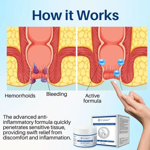 Hemorrhoidal Fissure Cream,Cvreoz,FAST EFFECTIVE, Advance Formula 30g - Picture 11 of 11