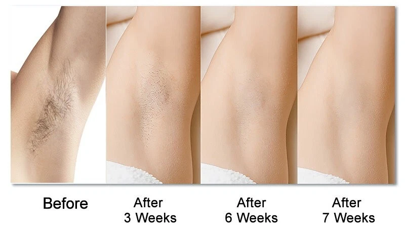 BDI Permanent IPL Hair Removal Device 400K Pulses Intense Pulsed Light Epilator - Picture 23 of 24