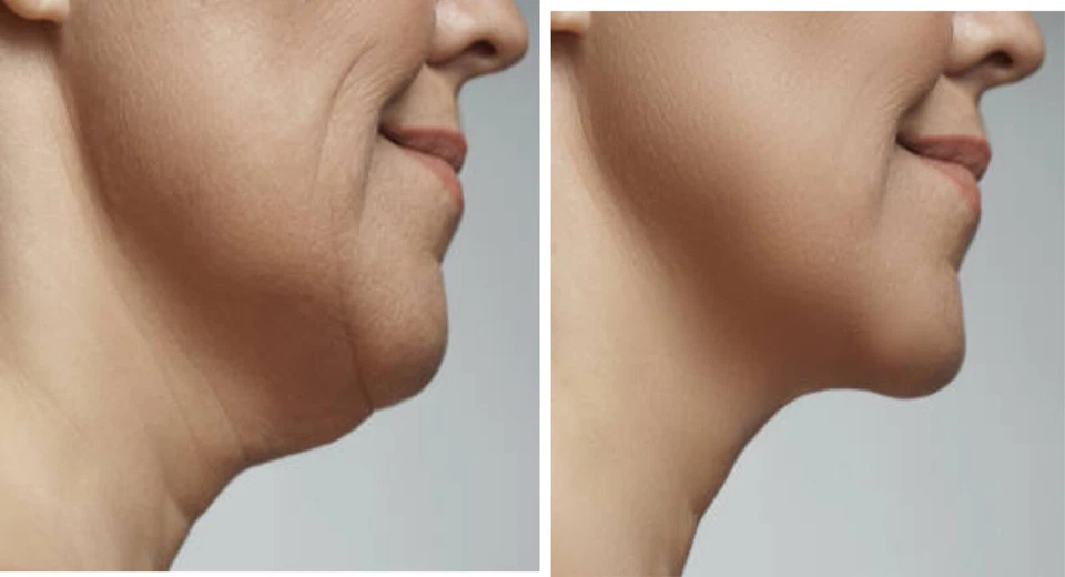 Biodroga Effect Care Lifting Boost Oil Concentrado 2ml-24pk. Paquete de ahorro Foto 3 de 4