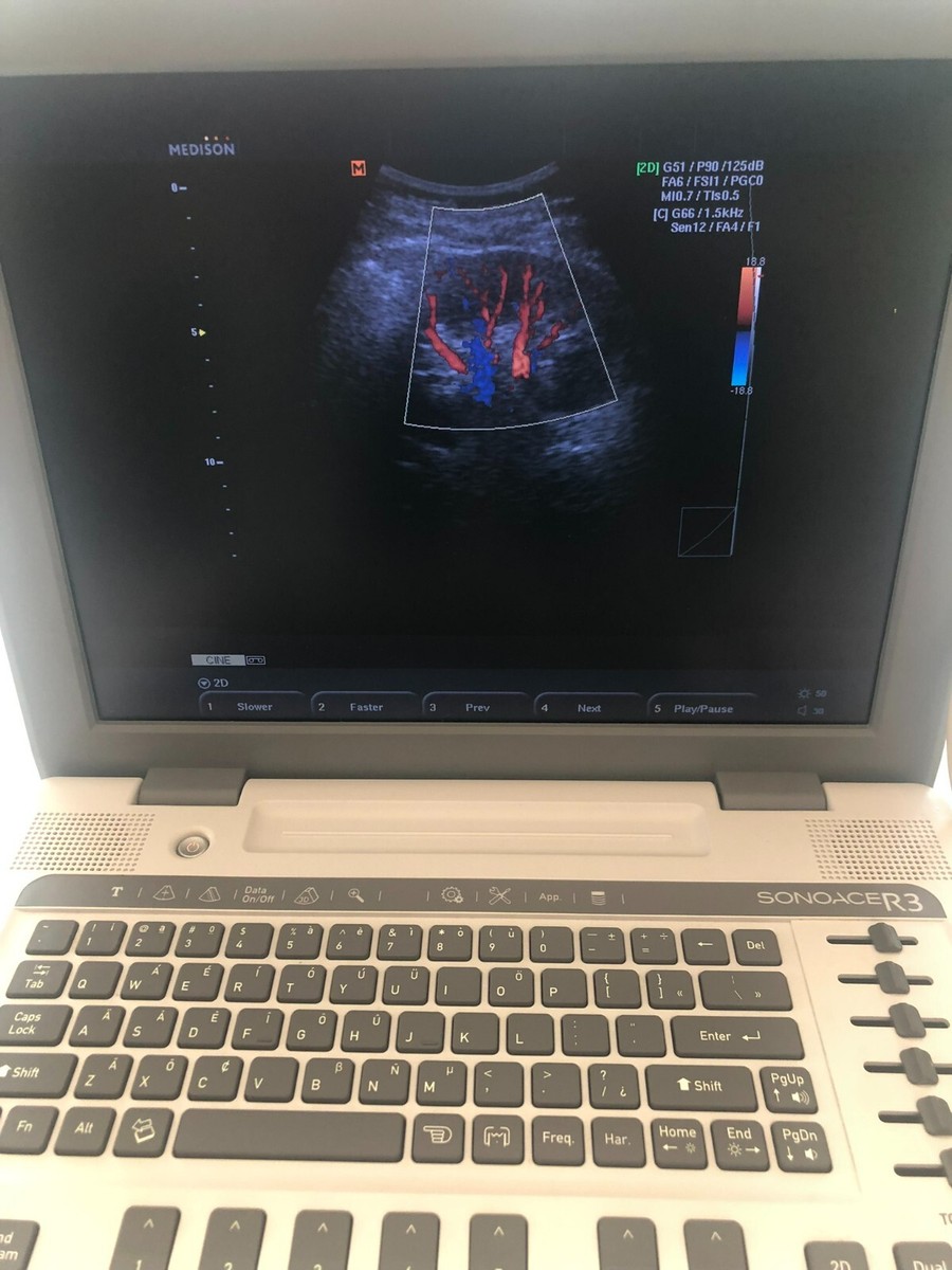 Samsung Medison Sonoace R3 Portable Ultrasound with LN5-12/40