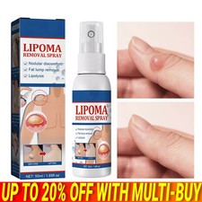 50ML Lipomheilung Reduction Spray, Instant LumpFree Lipoma Removal Spray USA Hot