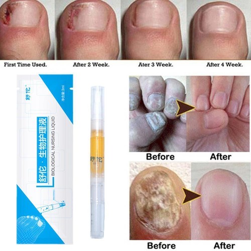 1-4* Tratamiento casero antifúngico Pen Toe Care tratamiento de hongos en las uñas Pen Liquid 2024- - Imagen 4 de 12