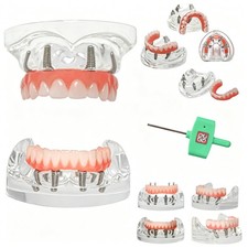 US Dental All-on-4 Overdenture Implant Model Upper/Lower Jaw-Clear With 4 Screws