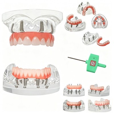 US Dental All-on-4 Overdenture Implant Model Upper/Lower Jaw-Clear With 4 Screws