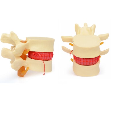 2Pcs Human Anatomy Lumbar Disc Herniation Model Medical Learn Aid Anatomy Model