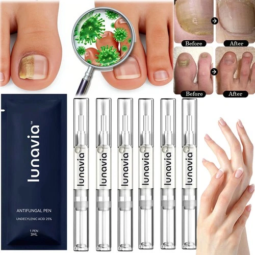 15 Pack Lunavia Antifungal Pen, 25% Undecylenic Acid – Toenail Fungus Treatment