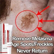 Powerful Dark Spot Remover – Fast Brightening, Melasma and Pigmentation