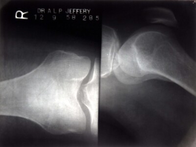 Genuine Vintage 1958 Hospital X Ray Human Joint Acetate Film Harley Street #B