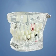 Dental Implant Model Teeth Model Tooth Dentist For Dental Disease Teaching