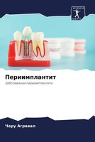 Charu Agrawal | Periimplantit | Taschenbuch | Russisch (2023) | Sciencia Scripts