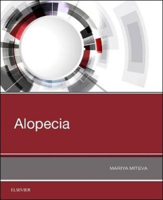 Alopecia by Miteva, Mariya I (Assistant Professor, Department of Dermatology