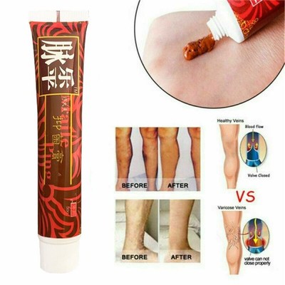 1PCS Varicose Veins Herbal Care Cream Ointment Leg Vasculitis Phlebitis Removal