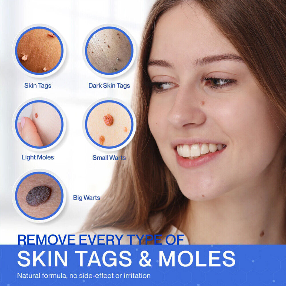 10ml Skin Tag Remover with Cotton Swab Skin Tag Mole Foot Corn Warts Treatment Skin Care Tool